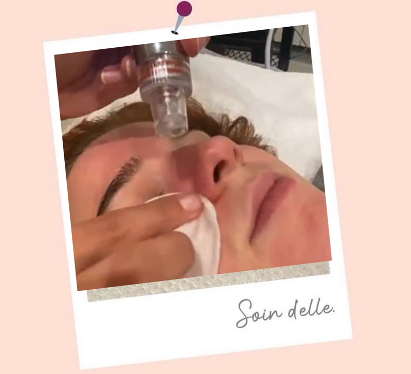 soin du visage par dermabrasion